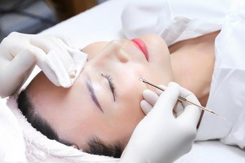 Quy trình lấy nhân điều trị mụn chuẩn y khoa