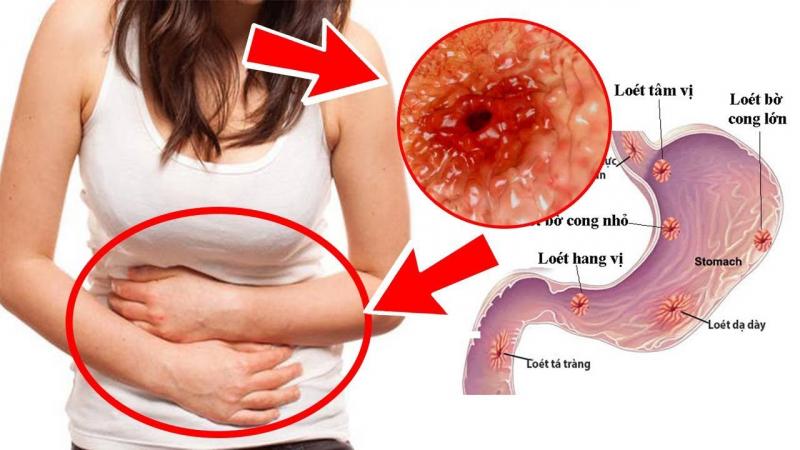 Hình ảnh Bệnh viện Chợ Rẫy – bệnh viện tuyến cuối lớn tại TP. Hồ Chí Minh, nổi bật với chuyên môn vững chắc và hệ thống hiện đại trong điều trị viêm loét dạ dày.