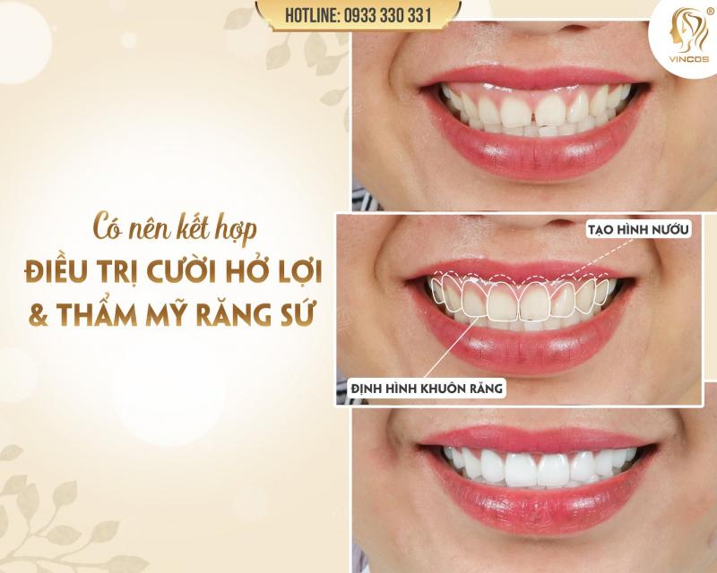 Địa chỉ cắt lợi VinCos & Dr Lee chuyên xử lý trường hợp phức tạp với công nghệ laser.
