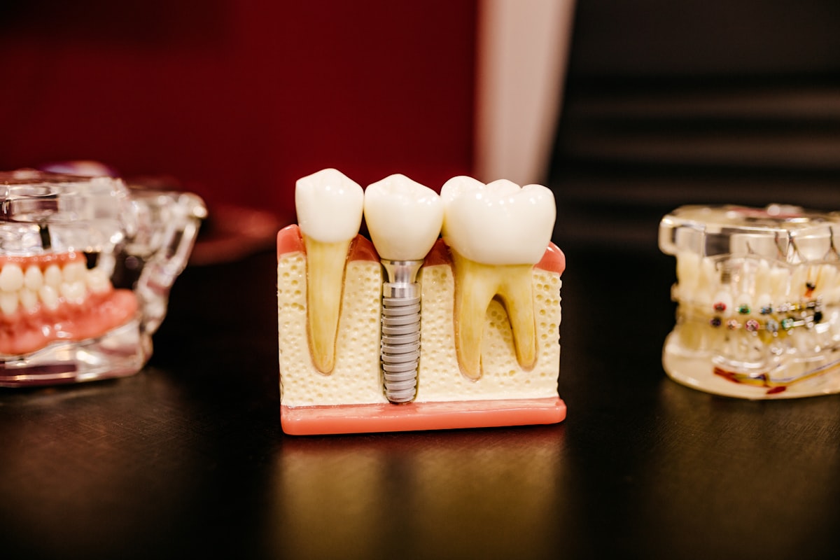 Mô hình implant nha khoa tại phòng khám