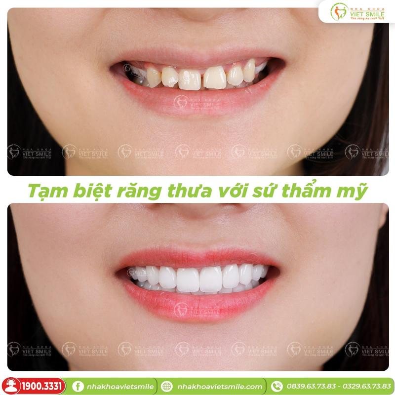 Trước và sau khi bọc răng sứ thẩm mỹ để khắc phục tình trạng răng thưa tại Nha Khoa Việt Smile.