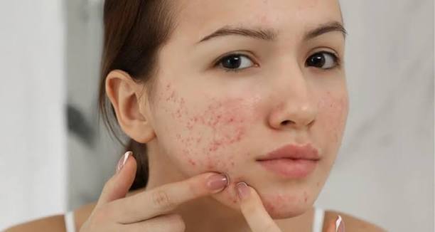 Làn da bị tổn thương cần serum Vitamin C trị thâm